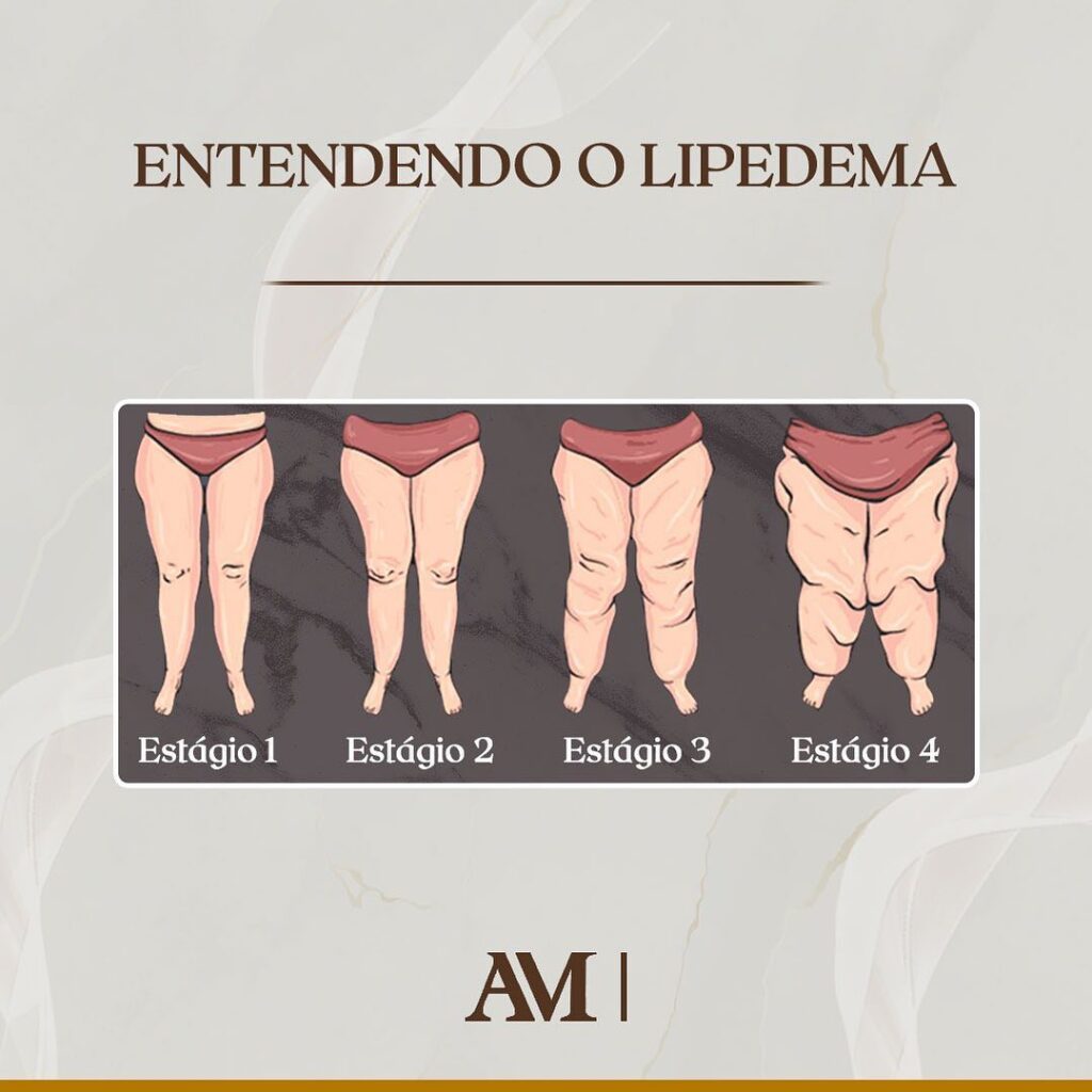 Entendendo o lipedema: Trata-se de uma condição médica pouco conhecida, mas que afeta um número significativo de pessoas, principalmente mulheres. Essa condição é caracterizada por uma distribuição anormal e simétrica de gordura nas extremidades inferiores do corpo, como pernas, coxas, quadris e, às vezes, braços. Embora algumas pessoas com lipedema possam ter um peso corporal normal em outras áreas, a acumulação de gordura nas regiões afetadas pode levar a confusões com a obesidade.